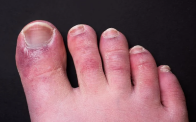 Chilblains